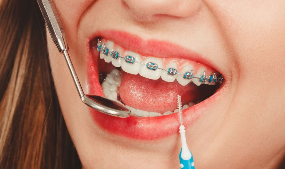 Braces in Colorado Springs